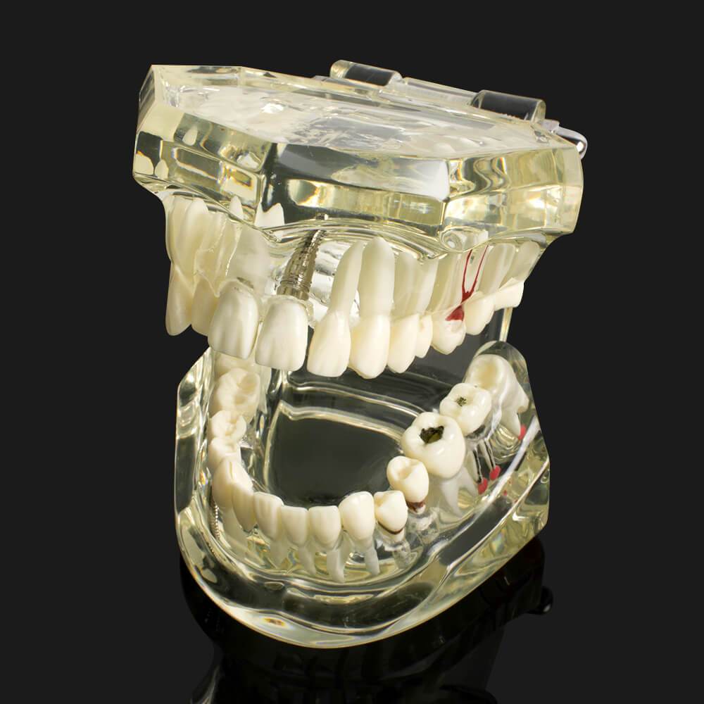 Dental implant disease tooth model with restoration with removable teeth