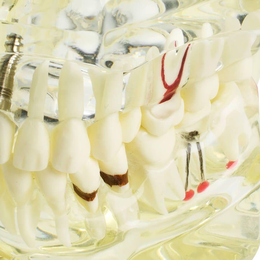 Dental implant disease tooth model with restoration with removable teeth