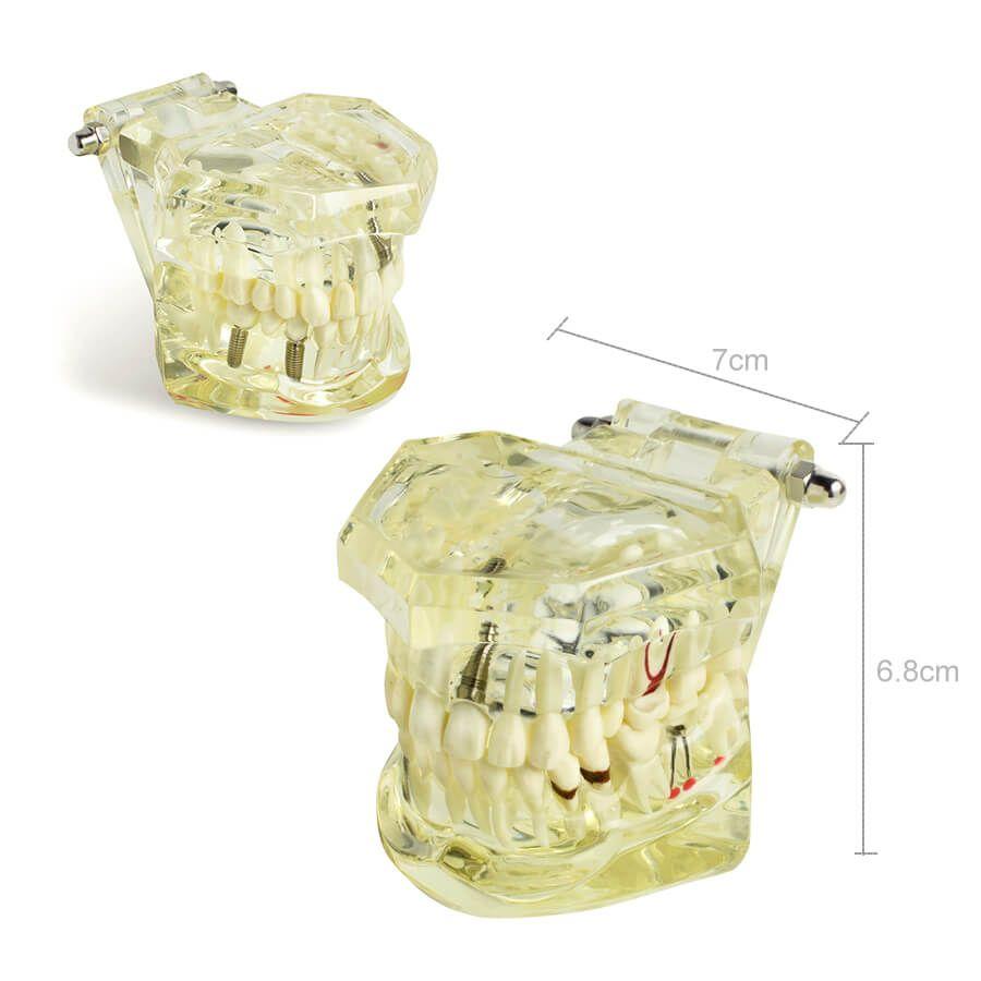 Dental implant disease tooth model with restoration with removable teeth