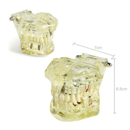 Dental implant disease tooth model with restoration with removable teeth