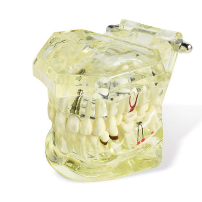 Dental implant disease tooth model with restoration with removable teeth