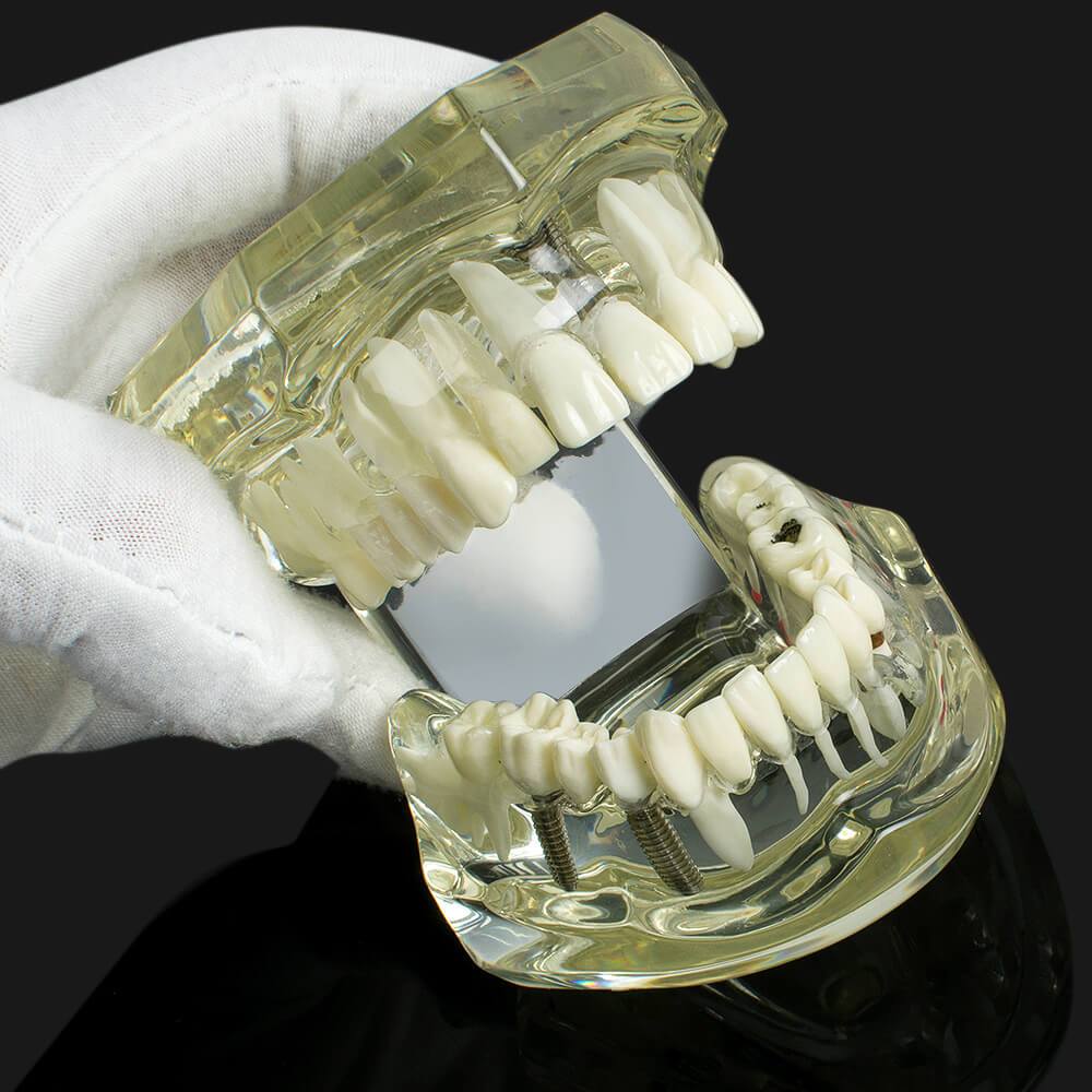 Dental implant disease tooth model with restoration with removable teeth