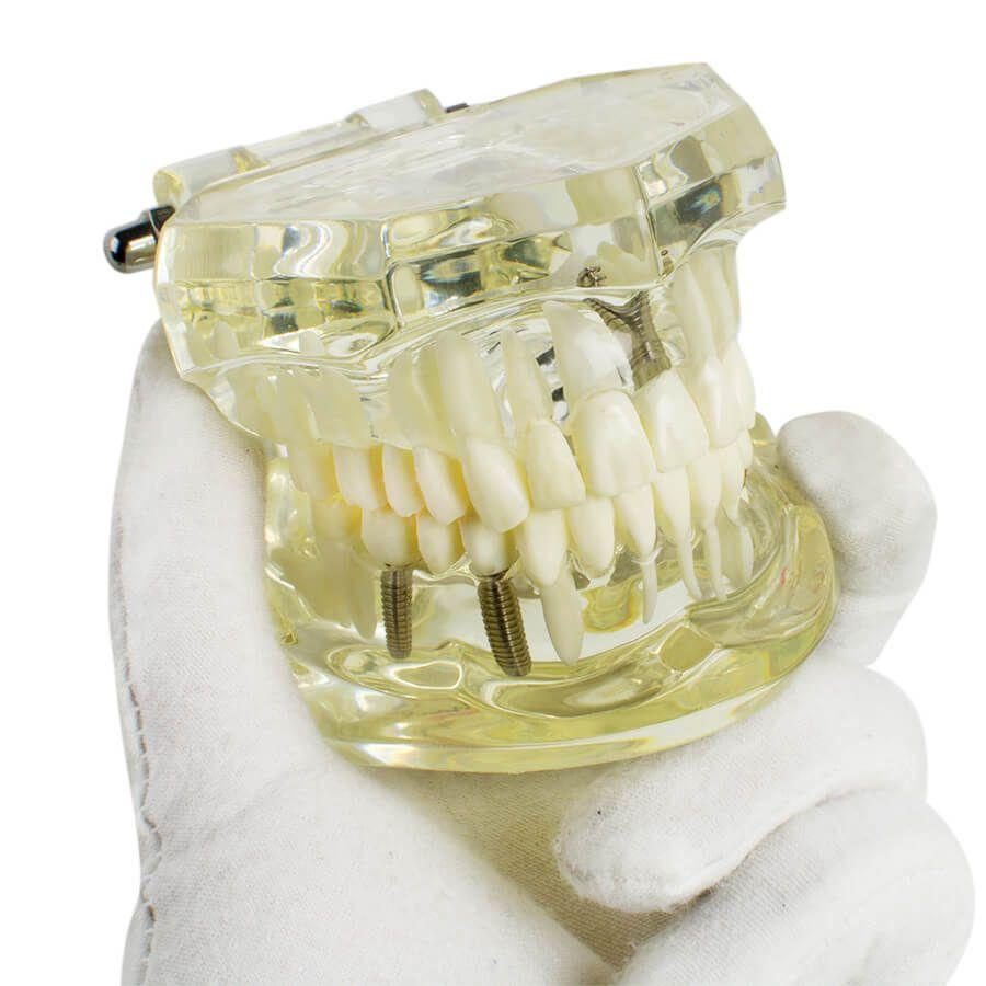 Dental implant disease tooth model with restoration with removable teeth