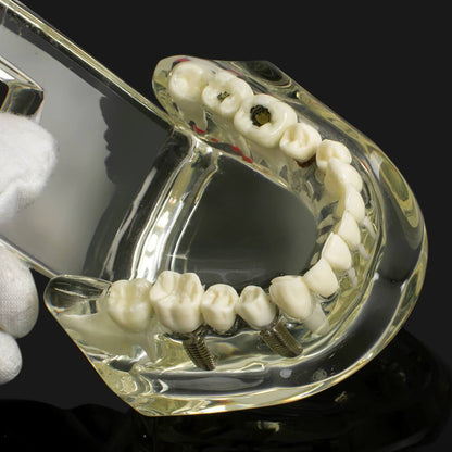 Dental implant disease tooth model with restoration with removable teeth