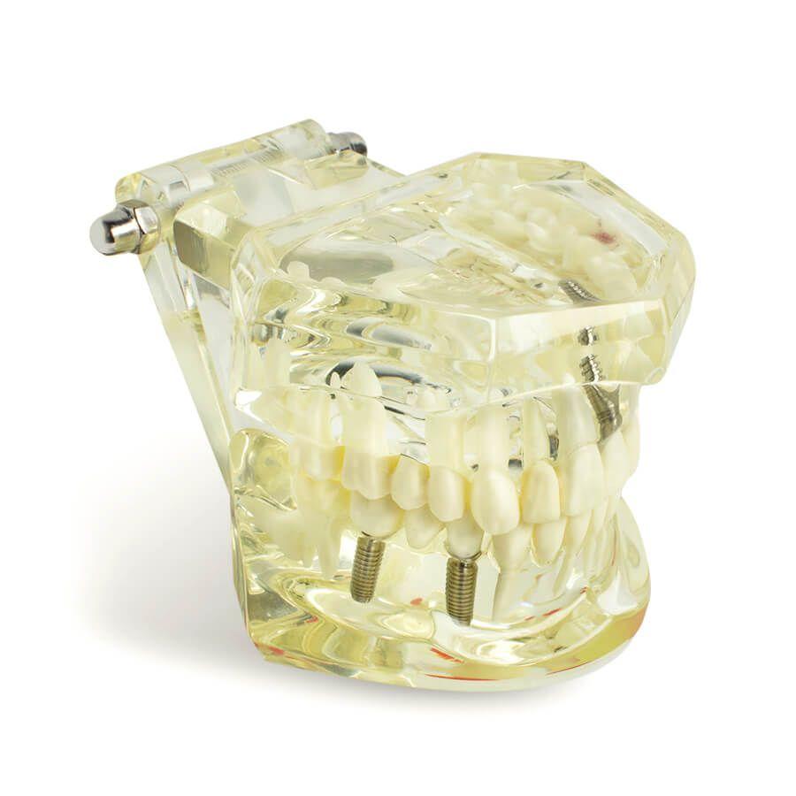 Dental implant disease tooth model with restoration with removable teeth