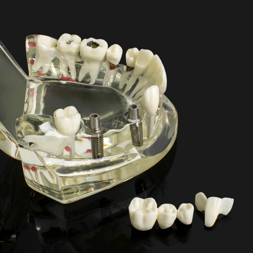 Dental implant disease tooth model with restoration with removable teeth