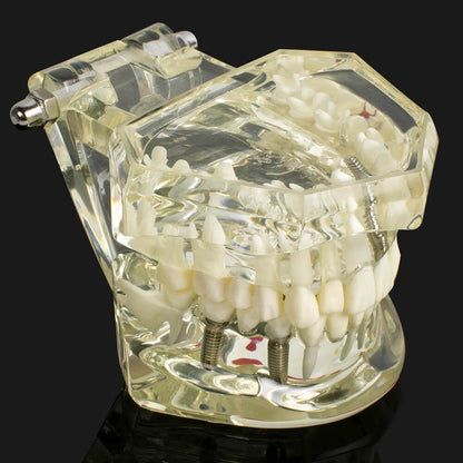 Dental implant disease tooth model with restoration with removable teeth