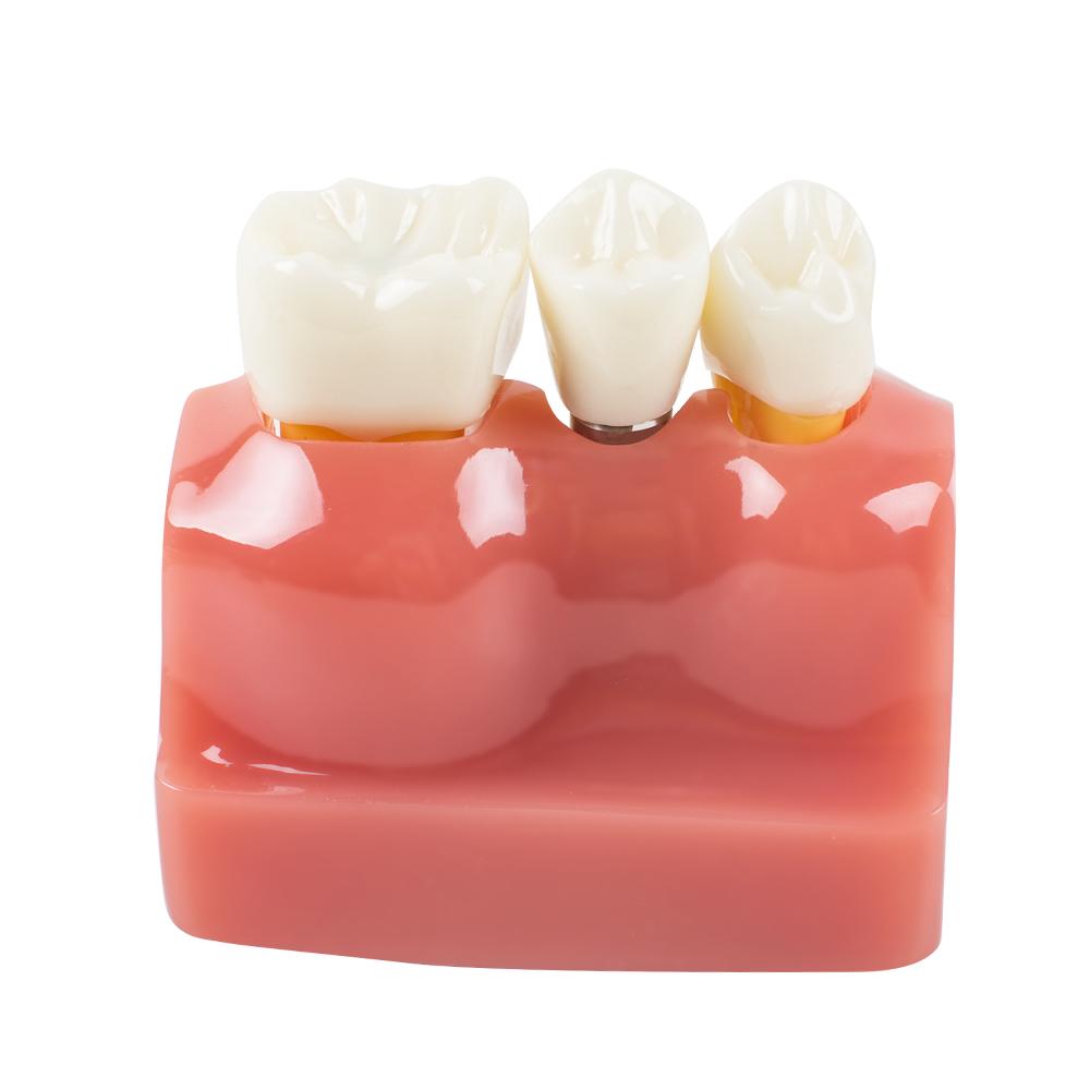 Dimostrazione dentale Denti Modello Analisi dell'impianto Crown Bridge