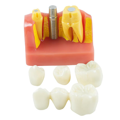 Dimostrazione dentale Denti Modello Analisi dell'impianto Crown Bridge