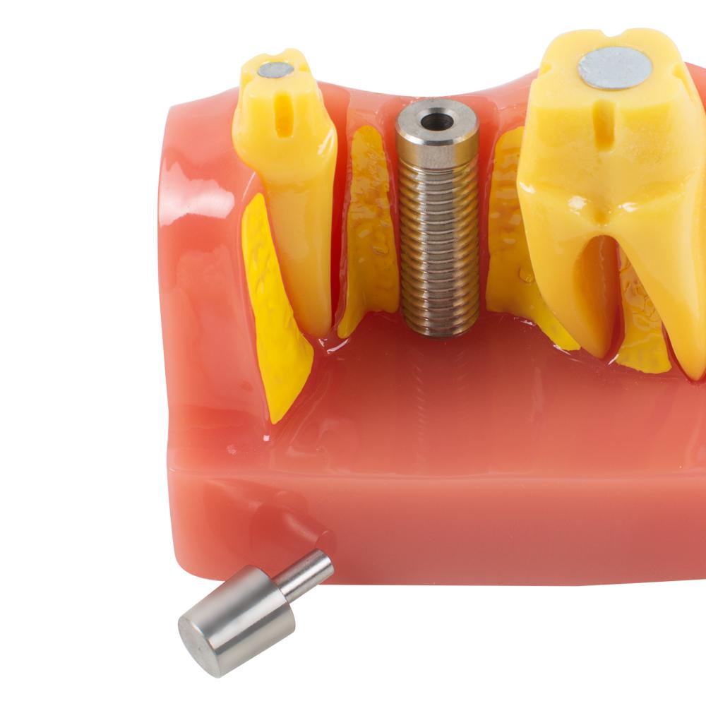 Dimostrazione dentale Denti Modello Analisi dell'impianto Crown Bridge